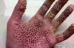 密集恐惧症图片,图片背后的心理奥秘